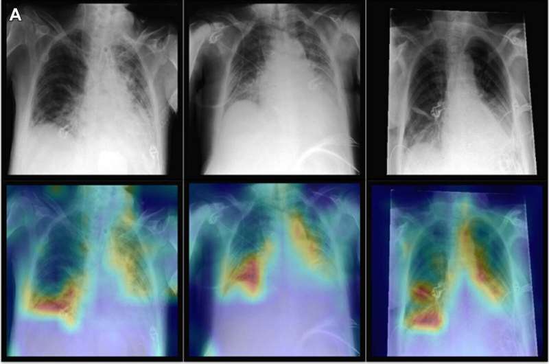 AI Could Detect Cancer in Chest X-Rays - 360PEO Inc.
