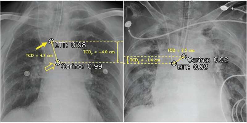AI confirms tracheal tube position on chest radiography
