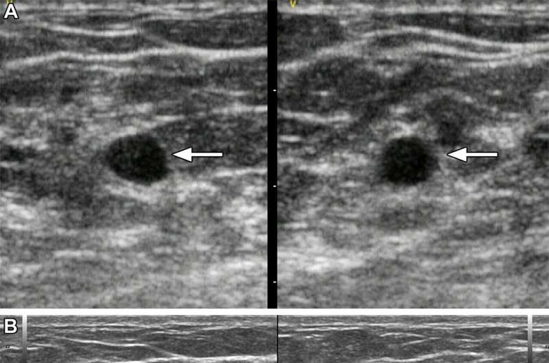 AI helpful in triaging breast masses in low-resource areas