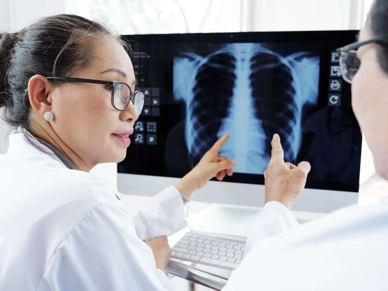 AI may equal trained staff in spotting TB on chest X-rays