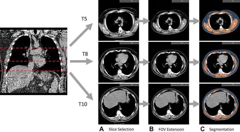 AI uses lung CT data to predict mortality risk