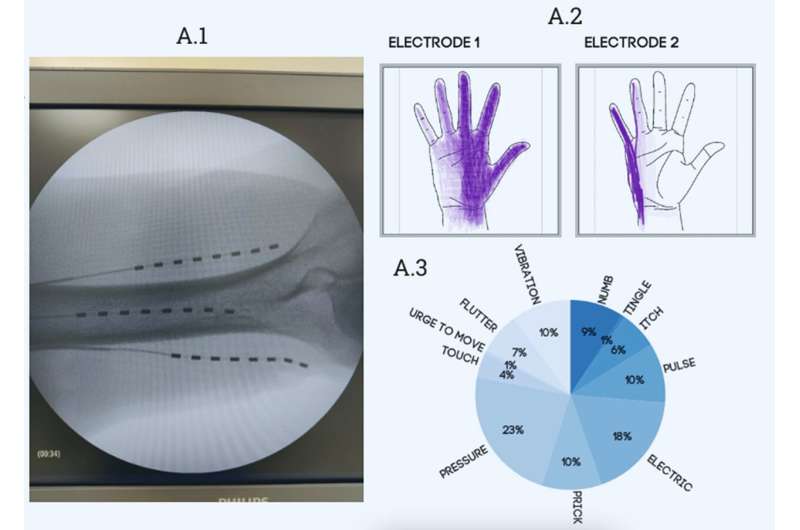 Amputees distinguish between objects using prosthetic hand, get relief from phantom pain