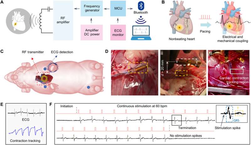 An implantable wireless cardiac pacemaker
