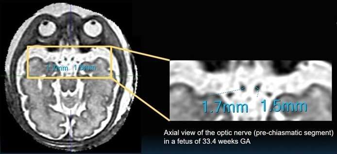 ARRS Annual Meeting: 3D SVR MRI helps delineate fetal optic nerve pathway