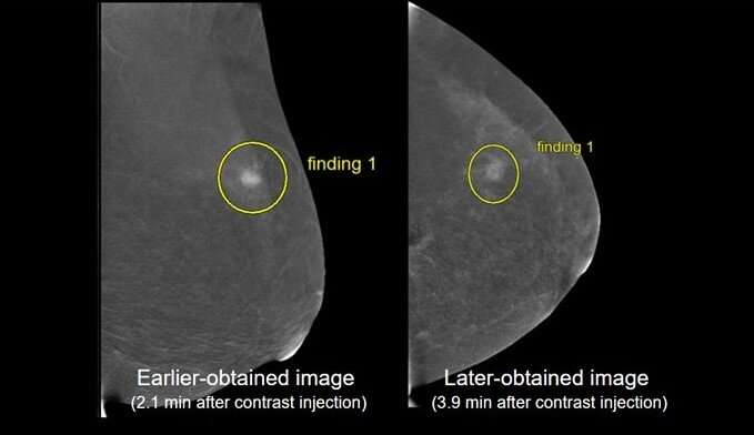 ARRS Annual Meeting: projection order, acquisition timing for contrast-enhanced mammography