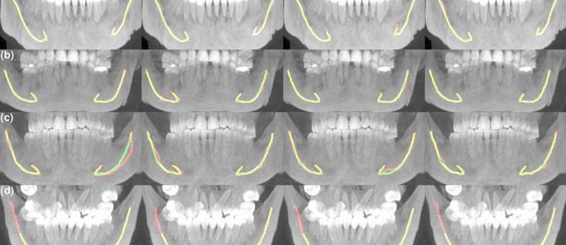 Artificial intelligence assists in dental care and jaw surgery