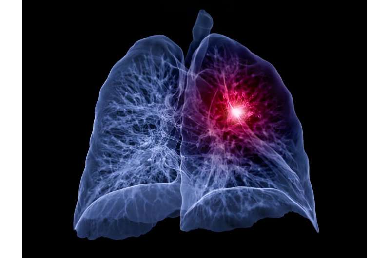 Atezolizumab monotherapy beneficial for NSCLC ineligible for platinum-based chemo