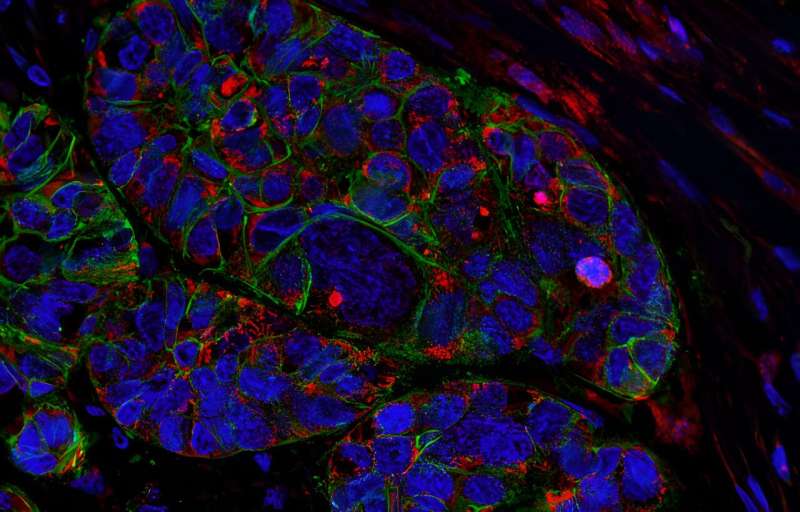 Attacking the roots of pancreatic cancer