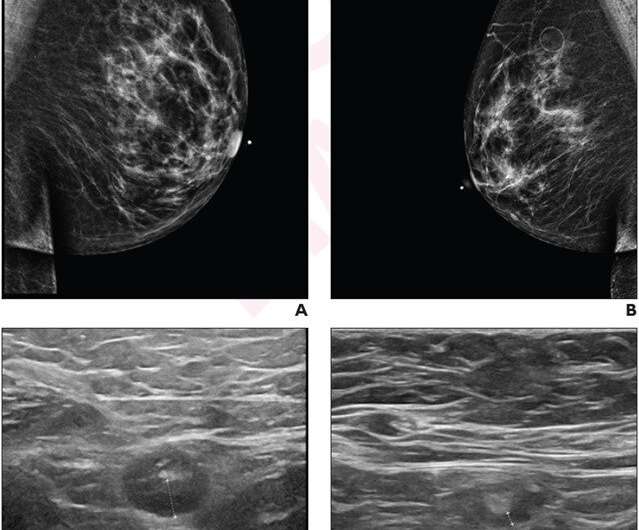 Axillary lymphadenopathy after COVID-19 vaccine booster—time to resolution on ultrasound follow-up