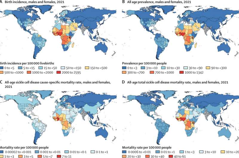 Basic levels of sickle cell care needed immediately; global mortality may be much higher than recorded