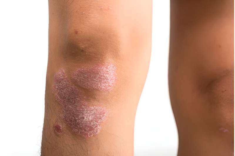 Biological agent trials for psoriasis rarely include patient images