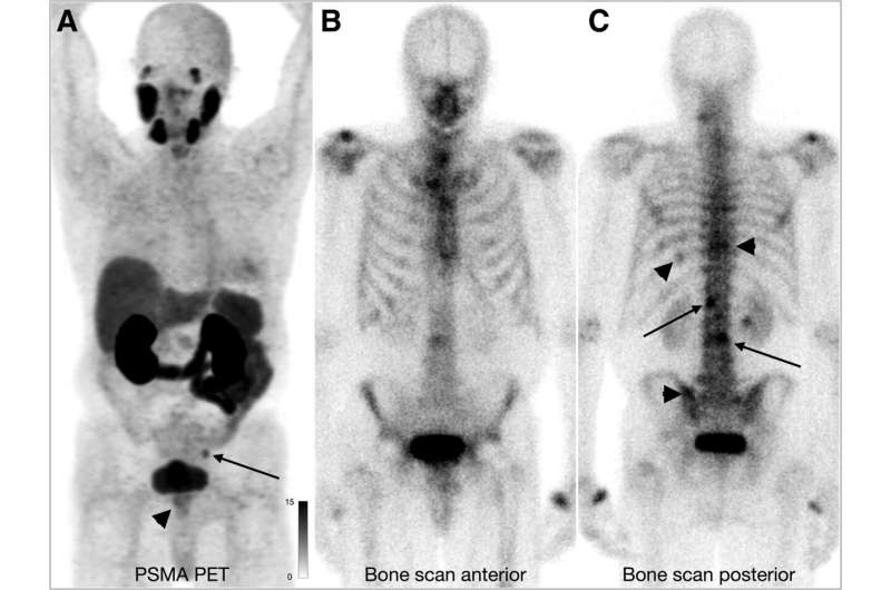 Bone scans overstage prostate cancer at initial staging compared with PSMA PET