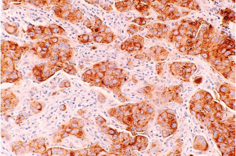 células de câncer de mama