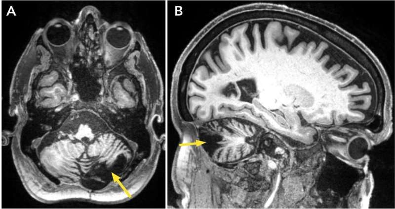 Case report shows promising results using transcranial magnetic stimulation for post-stroke ataxia