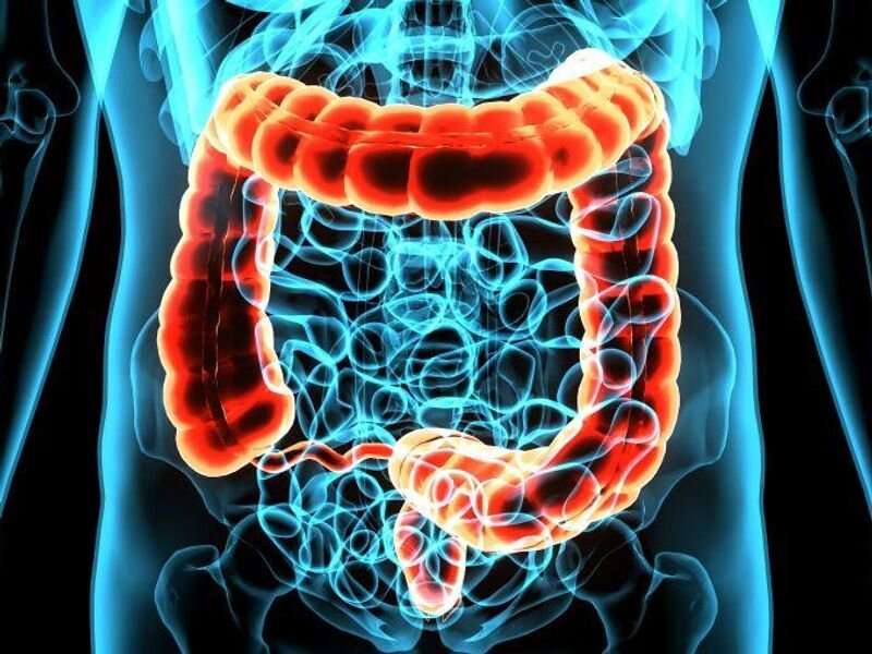 Changes in lifestyle habits linked to colorectal cancer risk