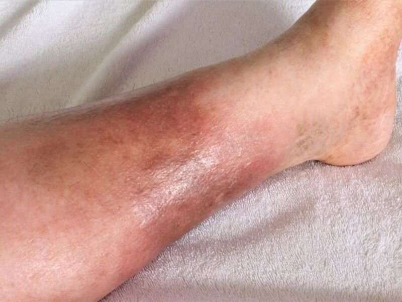 Chemotherapy-induced pseudocellulitis described in case reports