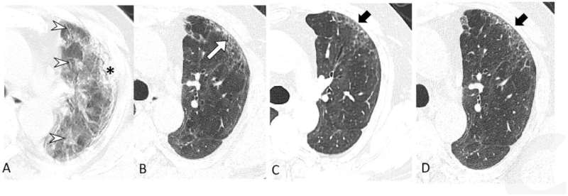 Chest CT shows lung abnormalities two years after COVID