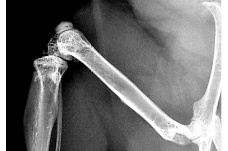 Chronic stress is bad for broken bones - How severe psychological stress impairs bone growth and fracture healing