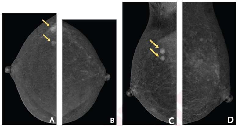 Clinical factors associated with background parenchymal enhancement on contrast-enhanced mammography