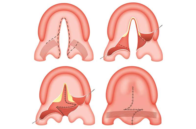 Combined technique provides new choice for cleft palate repair