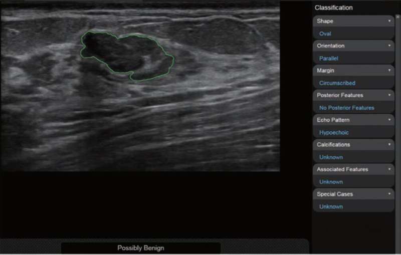 Computer‐aided diagnosis improves breast ultrasound expertise in multicenter study