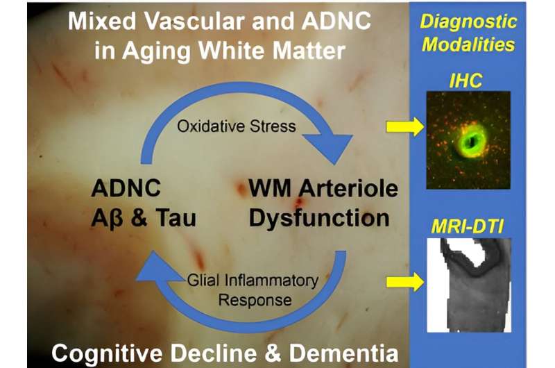 Contributions to white matter injury in Alzheimer's disease