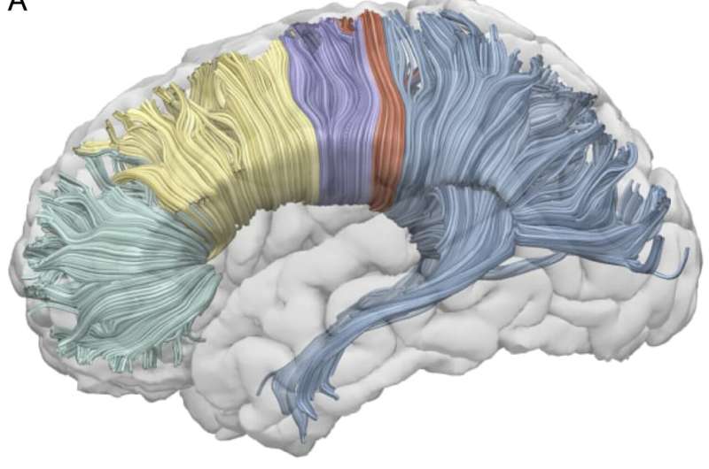 Corpus callosum found to switch off right hemisphere during speech