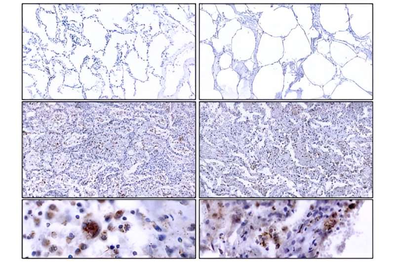 COVID-19 causes epigenetic lung scars