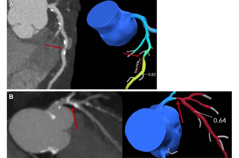 CT test simulates blood flow to assess risk in patients with angina