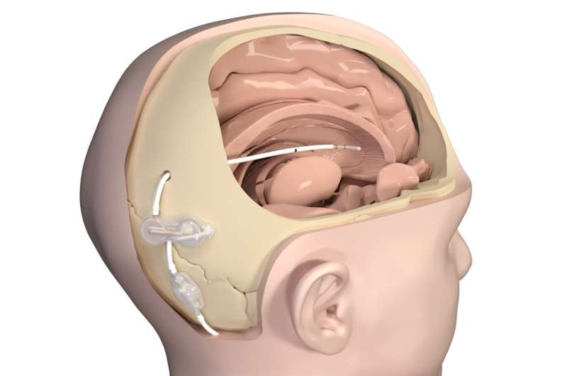 Daily flushing regimen with simple implant may prevent shunt clogs and reduce revision surgeries in patients with hydrocephalus