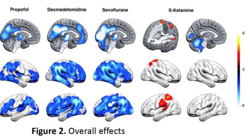 减少丘脑活动是在全身麻醉期间睡着了的关联——除了氯胺酮