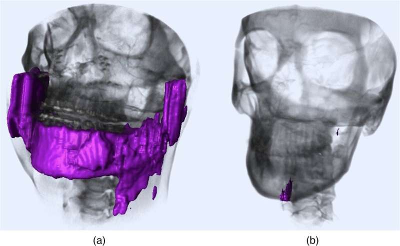 Deep-learning-based anatomical landmark identification in CT scans