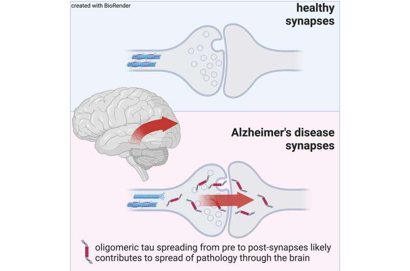 Dementia study reveals how toxic proteins spread through brain