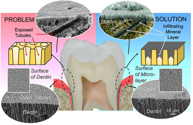 牙科菱形可以提供永久性治疗牙齿 敏感性