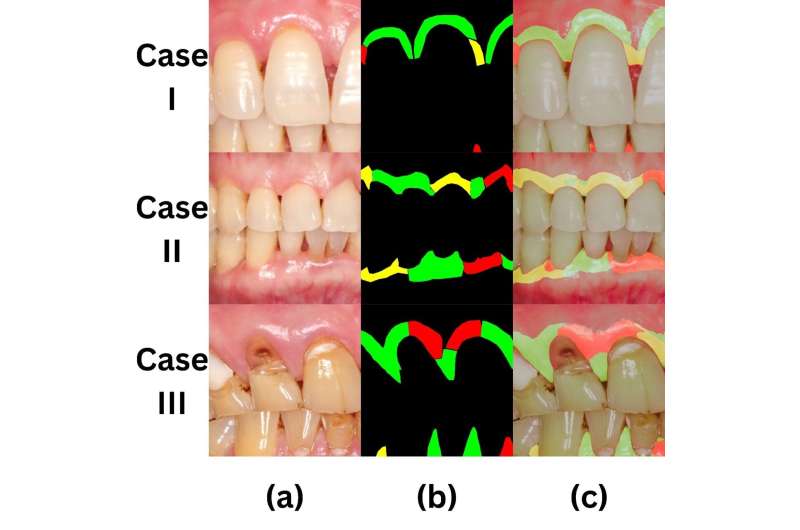 Dentistry team uses artificial intelligence for early detection of gum inflammation