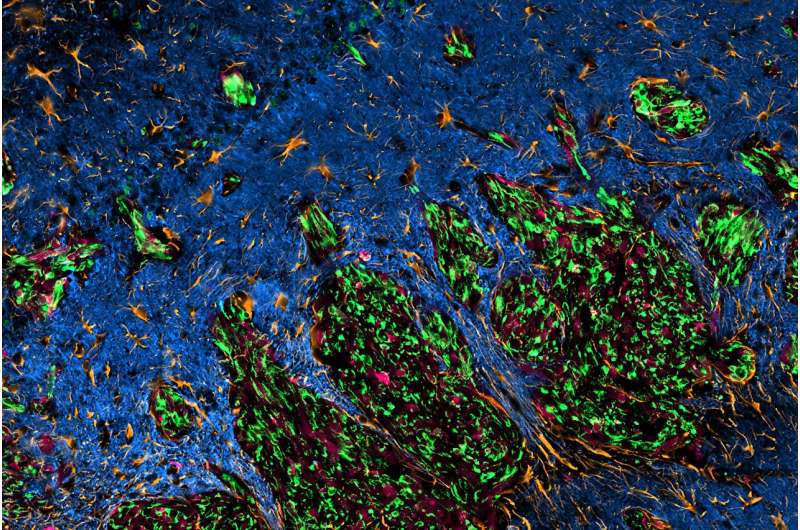 Discovery of protein-protein interaction lays foundation for future glioblastoma therapy