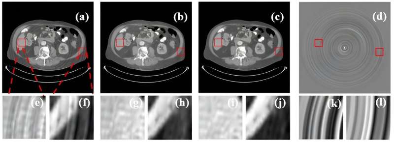 Double contrast learning helps to remove ring artifacts in computed tomography image