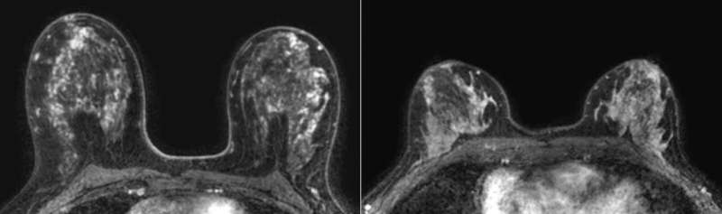 Elevated MRI enhancement ups cancer risk in women with very dense breasts