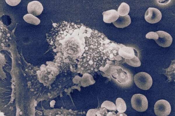 Engineered white blood cells eliminate cancer