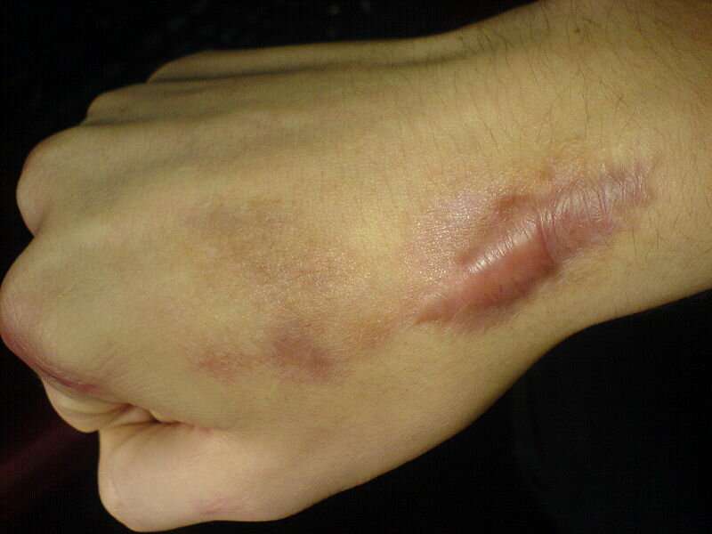 Excessive scarring shown to be associated with atopic eczema, hypertension and musculoskeletal diseases