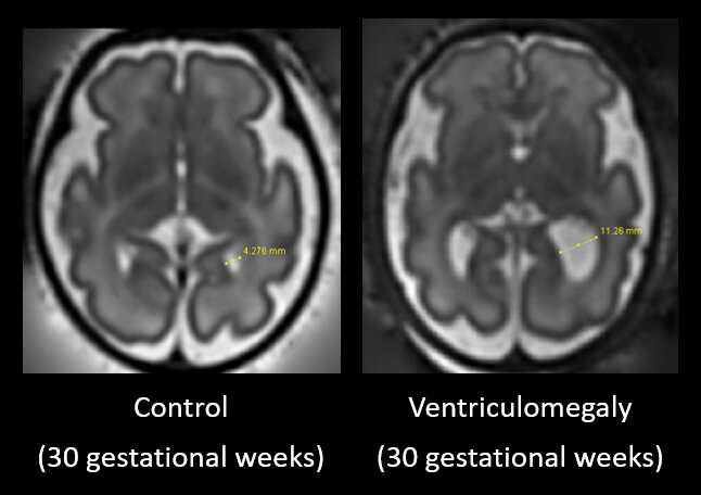 胎儿脑部扫描研究了孤独症的早期指标