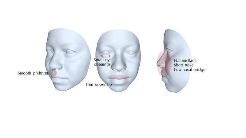 Foetal alcohol syndrome: facial modelling study explores technology to aid diagnosis