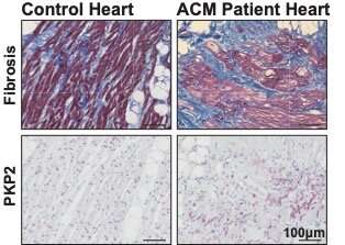 From mutation to arrhythmia: desmosomal protein breakdown as an underlying mechanism of cardiac disease