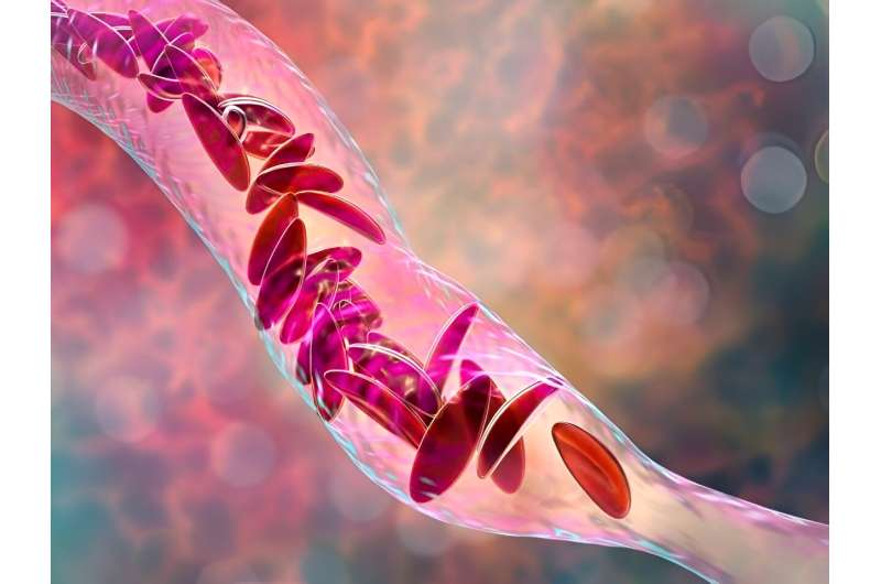 Gene-tweaked stem cells offer hope against sickle cell disease