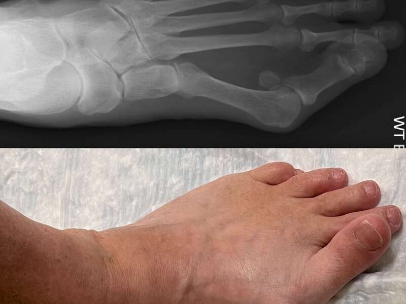 Got bunions? key factors to whether surgery will work for you