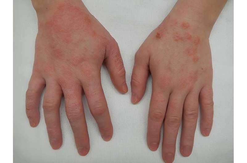 Gut-skin connection is key factor in atopic dermatitis, research review shows