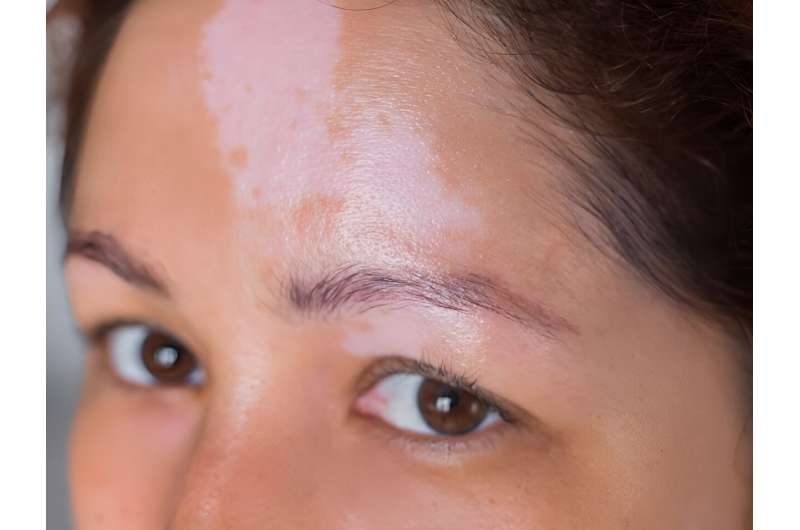 Half of patients with newly diagnosed vitiligo do not receive treatment