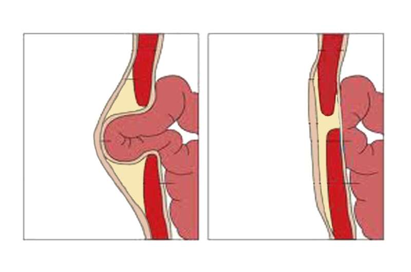 Hernia—a common, treatable condition no one talks about