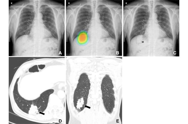 High accuracy AI improves lung cancer detection