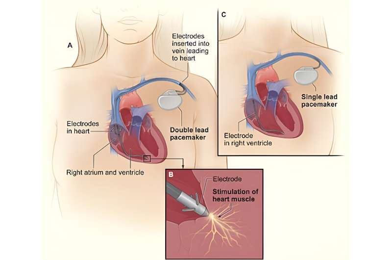 How do pacemakers and defibrillators work? A cardiologist explains how they interact with the electrical system of the heart